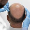 Which is the Best Hair Transplant Clinic in Hyderabad? What You Should Know Before Choosing a Clinic?
